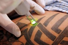 Читать новость Эффективное сведение татуировки при помощи лазера