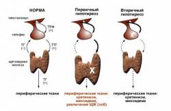 Читать новость Чем опасен гипотериоз