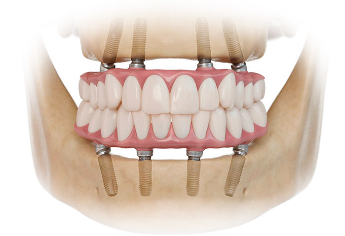 Почему протезирование зубов «все на 4» - верное решение