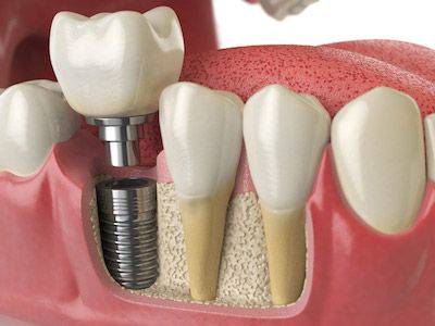 Костная пластика при имплантации зубов